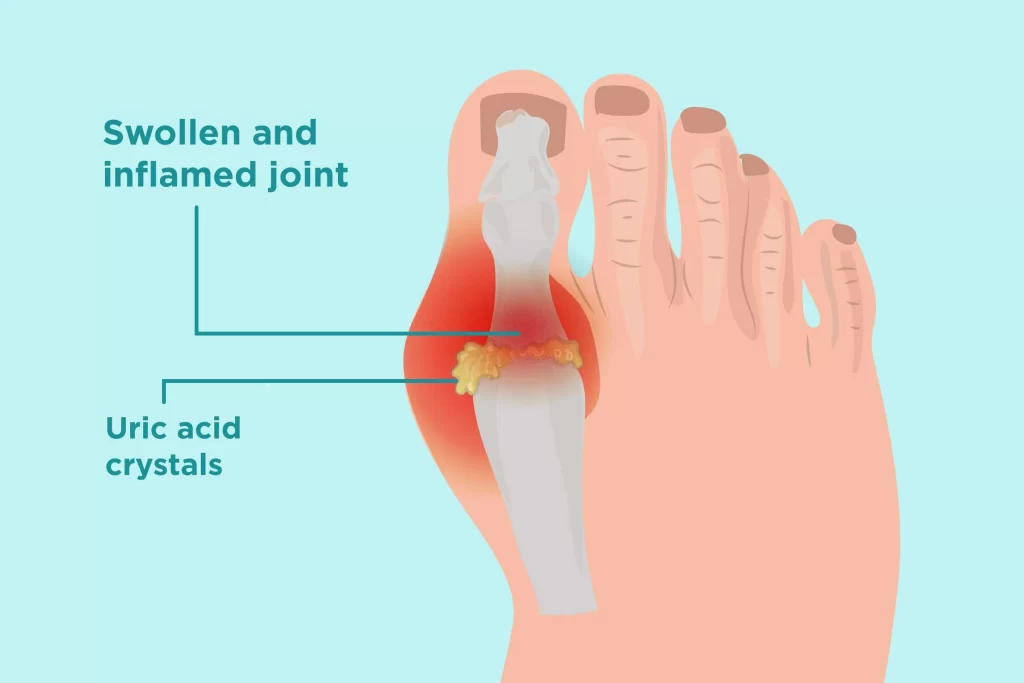 Gout Remedies That Really Work