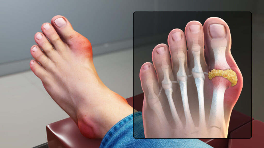 Natural Gout Remedies